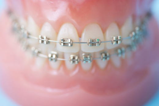 矯正治療したのに後戻り？～リテーナーってなに？～ | 埼玉県戸田市